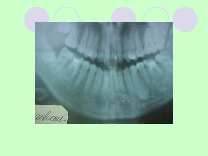 2. Хрящеобразующие Хондрома l Экхондрома  l Эндохондрома  потенциально  на верхней челюсти