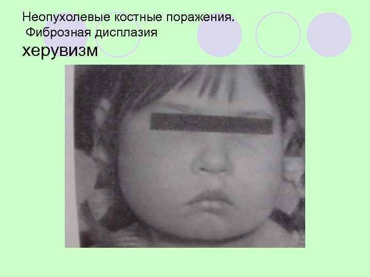 Синдром Олбрайта 