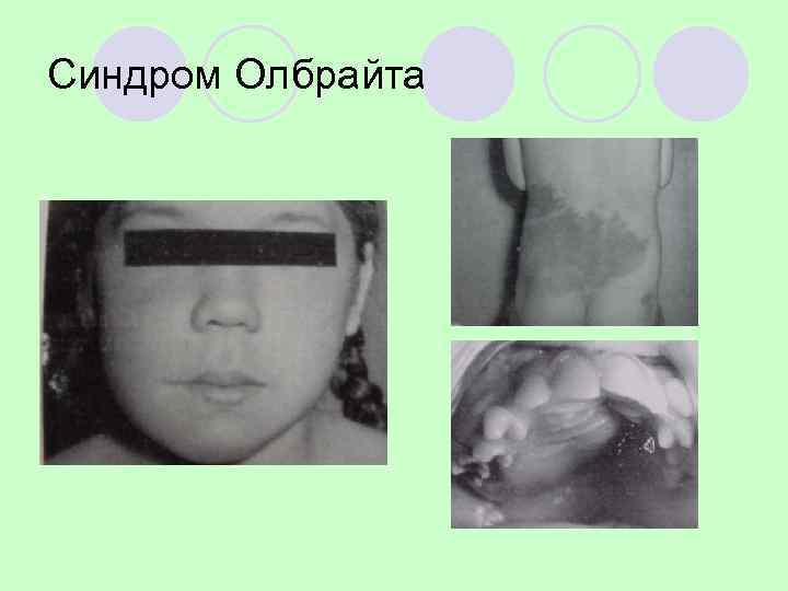 Фиброзная дисплазия монооссальная форма 