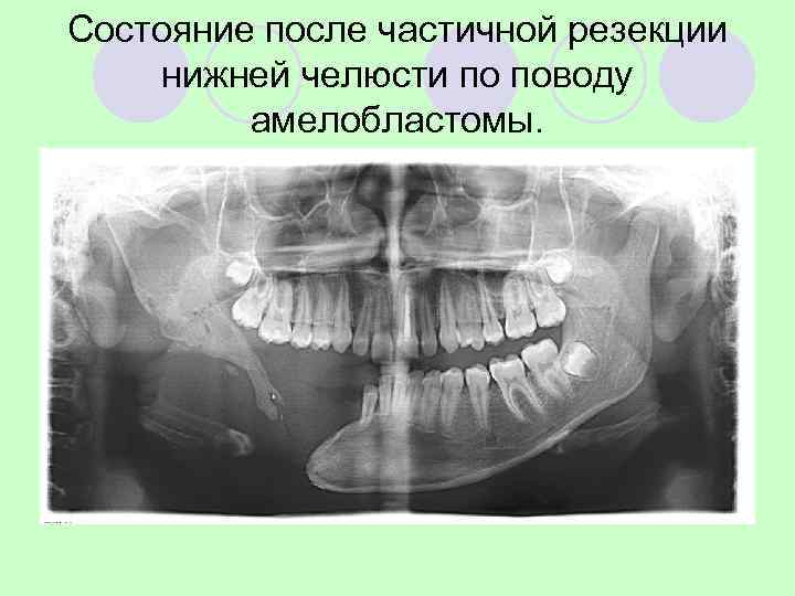 Распространенность одонтогенных кист достигает 75% среди всей костной патологии детского возраста  l Возраст
