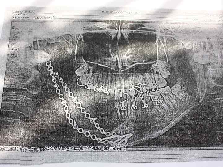 DS: Радикулярная киста нижней челюсти слева от зуба 75 … 