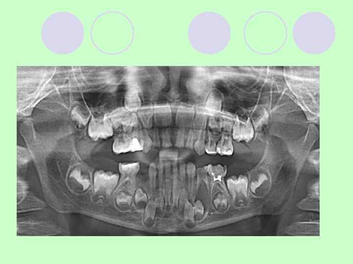 Воспалительная корневая киста l Гистологически –  оболочка из  фиброзной ткани l Содержит