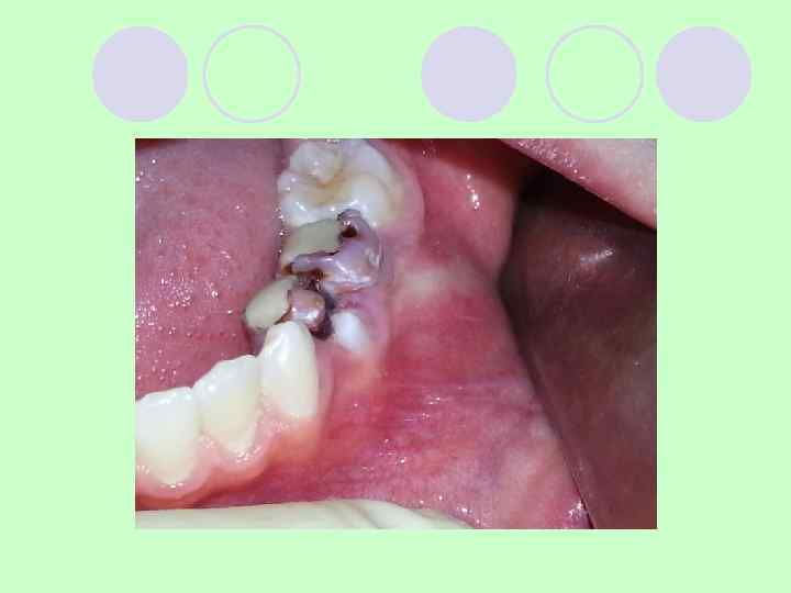Радикулярная киста нижней челюсти от 85 зуба l Девочка , 12 лет.  85