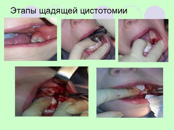 l В 83% случаев молочные моляры были  лечены по поводу пульпита резорцин- 