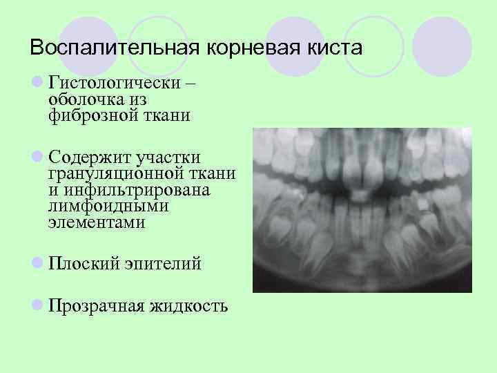 Щадящий метод лечения радикулярной кисты нижней челюсти от молочного зуба 