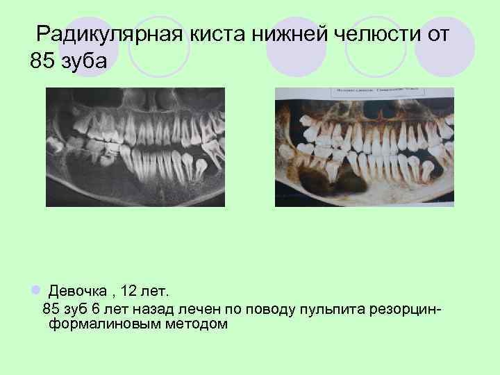 верхняя челюсть - киста более 1, 5 см. - цистэктомия 