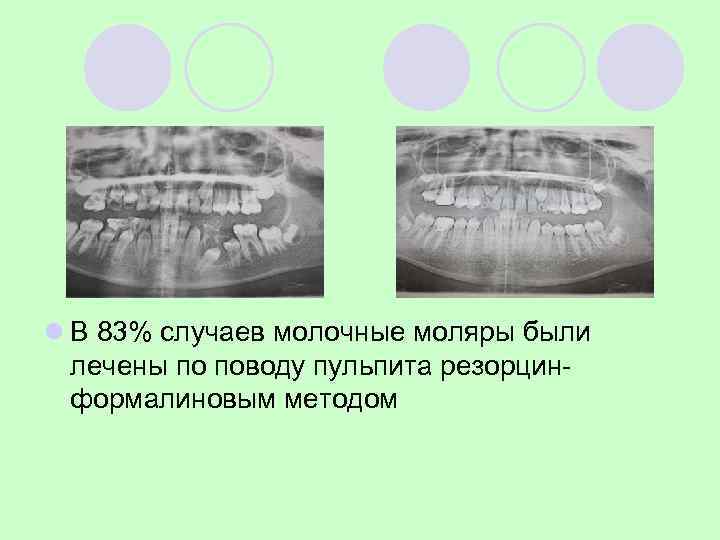 Осложнения лечения пульпита молочных зубов l Девочка , 12 лет. l Радикулярная киста верхней