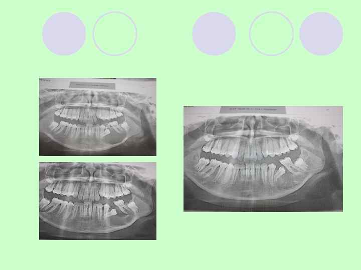 Фолликулярная киста нижней челюсти 