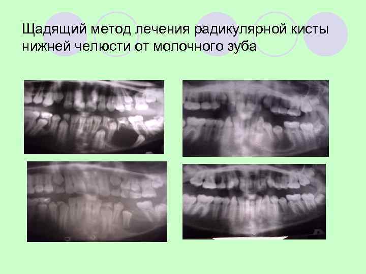 Профилактика. Исключить: курение, наркотики, алкоголь, травмы ……. . Рутинный осмотр и пальпация. Ro- диагностика?