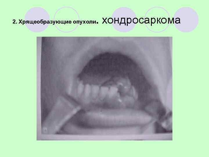 3. Гигантоклеточная опухоль (остеокластома)      l Литическая   