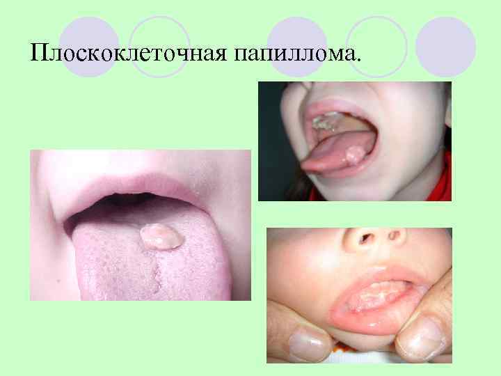 Плоскоклеточная папиллома. 