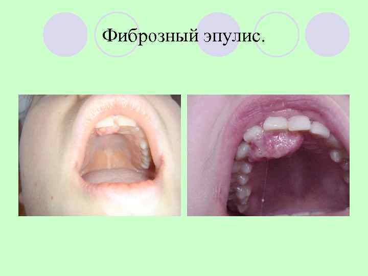 Фиброзный эпулис. 