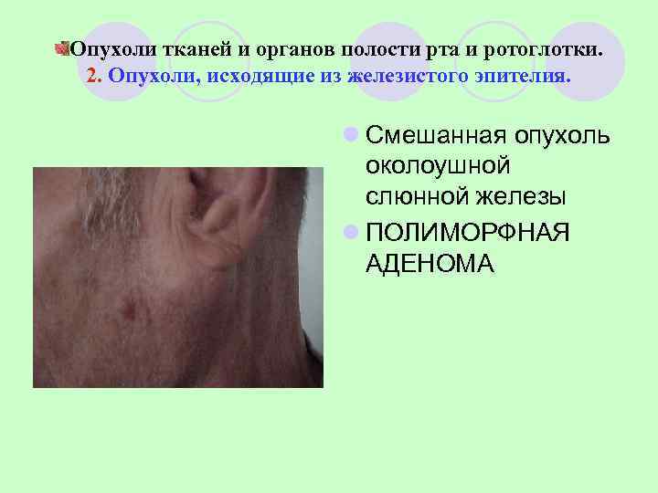 Опухоли тканей и органов полости рта и ротоглотки.  2. Опухоли, исходящие из железистого