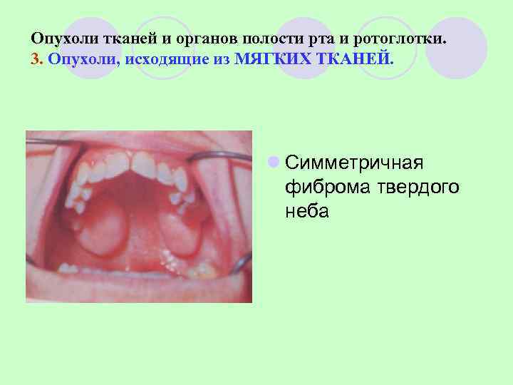 Опухоли тканей и органов полости рта и ротоглотки. 3. Опухоли, исходящие из МЯГКИХ ТКАНЕЙ.
