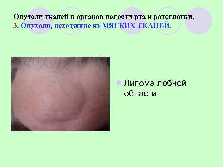 Опухоли тканей и органов полости рта и ротоглотки. 3. Опухоли, исходящие из МЯГКИХ ТКАНЕЙ.