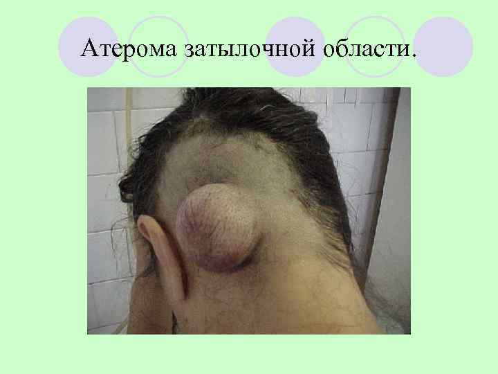 Атерома затылочной области. 