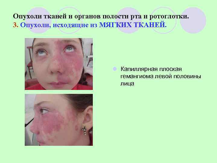 Опухоли тканей и органов полости рта и ротоглотки. 3. Опухоли, исходящие из МЯГКИХ ТКАНЕЙ.