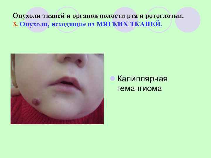 Опухоли тканей и органов полости рта и ротоглотки. 3. Опухоли, исходящие из МЯГКИХ ТКАНЕЙ.