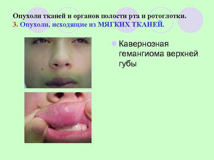 Опухоли тканей и органов полости рта и ротоглотки. 3. Опухоли, исходящие из МЯГКИХ ТКАНЕЙ.