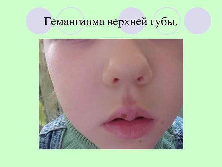 Гемангиома верхней губы. 