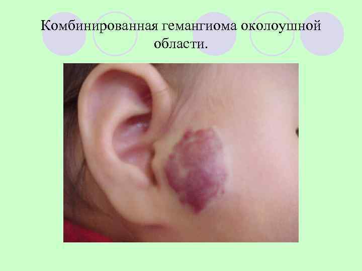 Комбинированная гемангиома околоушной    области. 