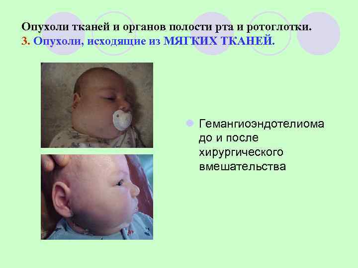 Опухоли тканей и органов полости рта и ротоглотки. 3. Опухоли, исходящие из МЯГКИХ ТКАНЕЙ.