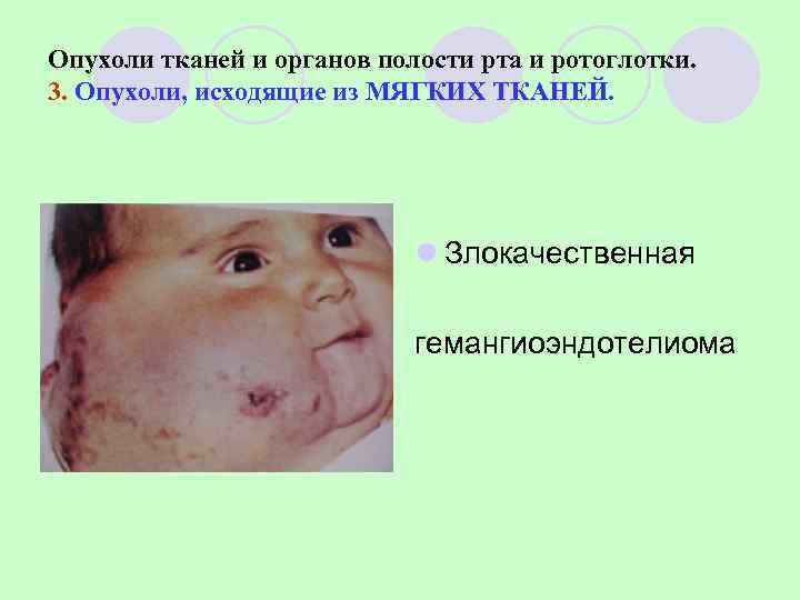 Опухоли тканей и органов полости рта и ротоглотки. 3. Опухоли, исходящие из МЯГКИХ ТКАНЕЙ.