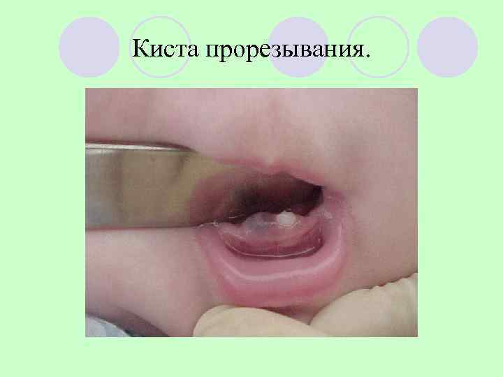 Киста прорезывания. 