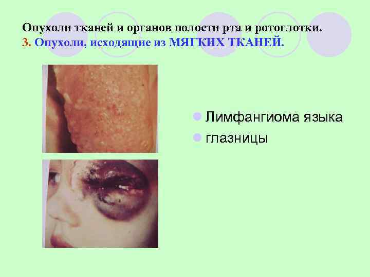 Опухоли тканей и органов полости рта и ротоглотки. 3. Опухоли, исходящие из МЯГКИХ ТКАНЕЙ.