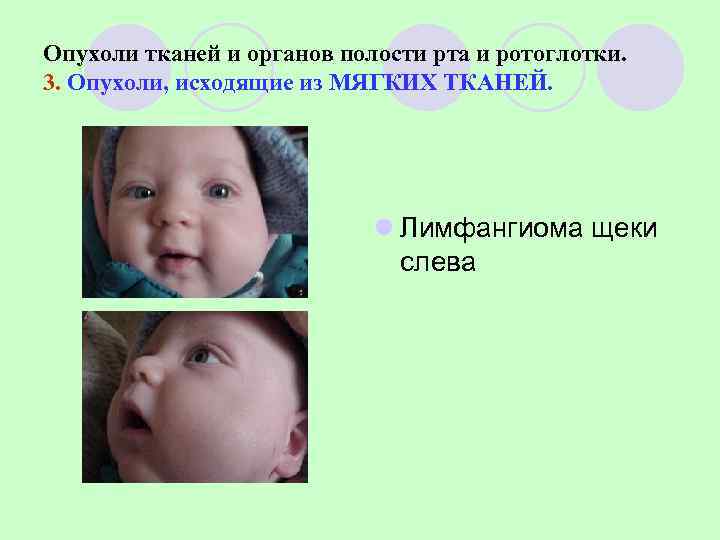 Опухоли тканей и органов полости рта и ротоглотки. 3. Опухоли, исходящие из МЯГКИХ ТКАНЕЙ.