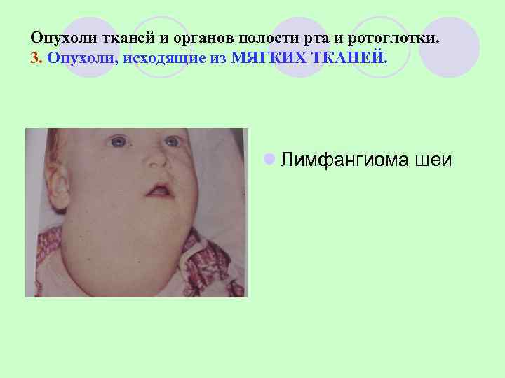 Опухоли тканей и органов полости рта и ротоглотки. 3. Опухоли, исходящие из МЯГКИХ ТКАНЕЙ.