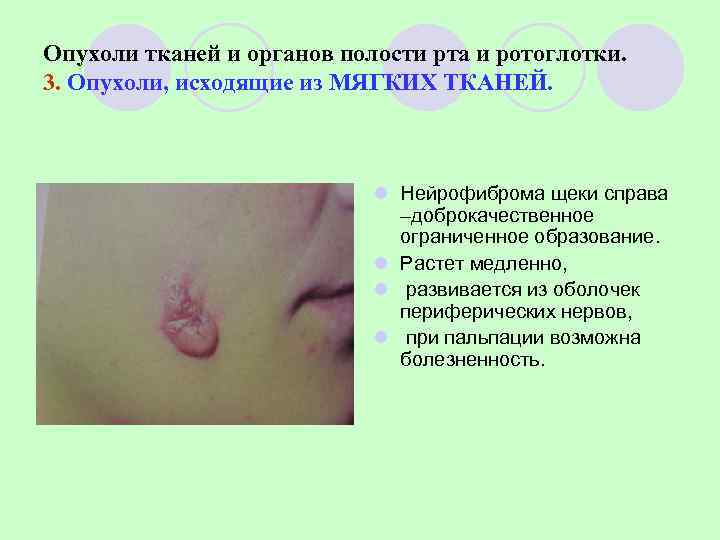Опухоли тканей и органов полости рта и ротоглотки. 3. Опухоли, исходящие из МЯГКИХ ТКАНЕЙ.