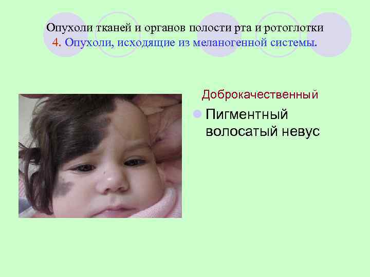 Опухоли тканей и органов полости рта и ротоглотки 4. Опухоли, исходящие из меланогенной системы.