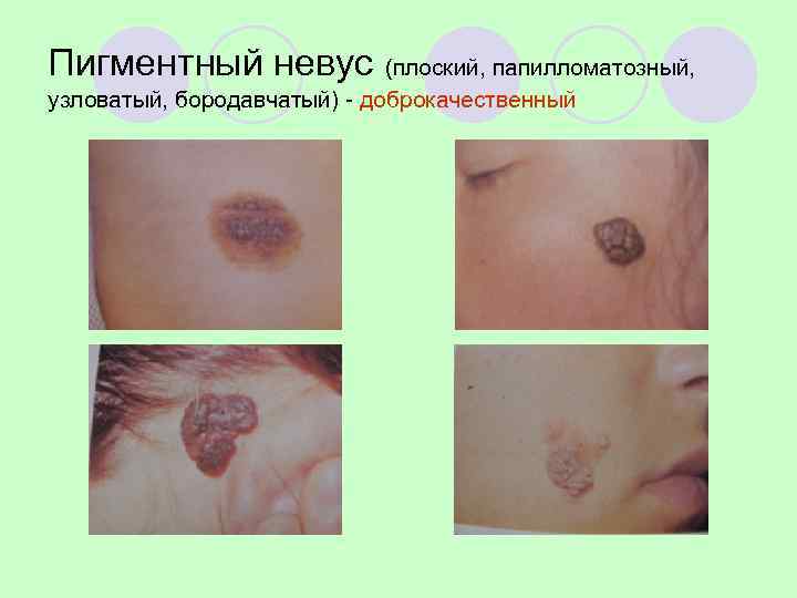 Пигментный невус   (плоский, папилломатозный, узловатый, бородавчатый) - доброкачественный 