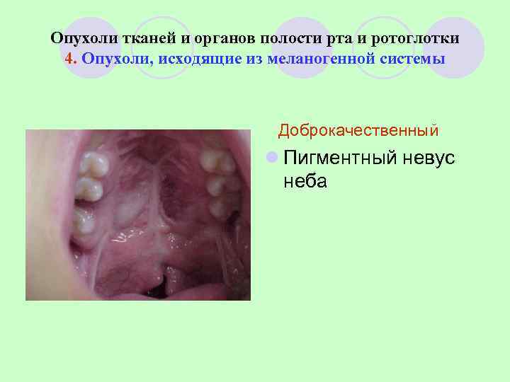 Опухоли тканей и органов полости рта и ротоглотки 4. Опухоли, исходящие из меланогенной системы