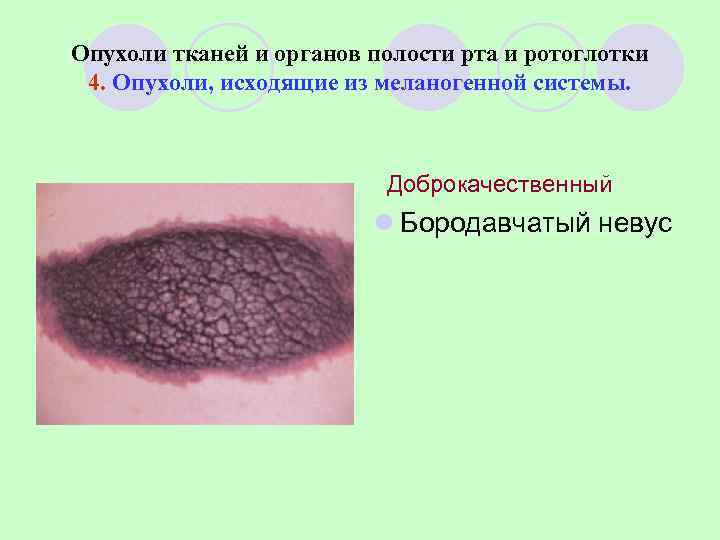 Опухоли тканей и органов полости рта и ротоглотки 4. Опухоли, исходящие из меланогенной системы.