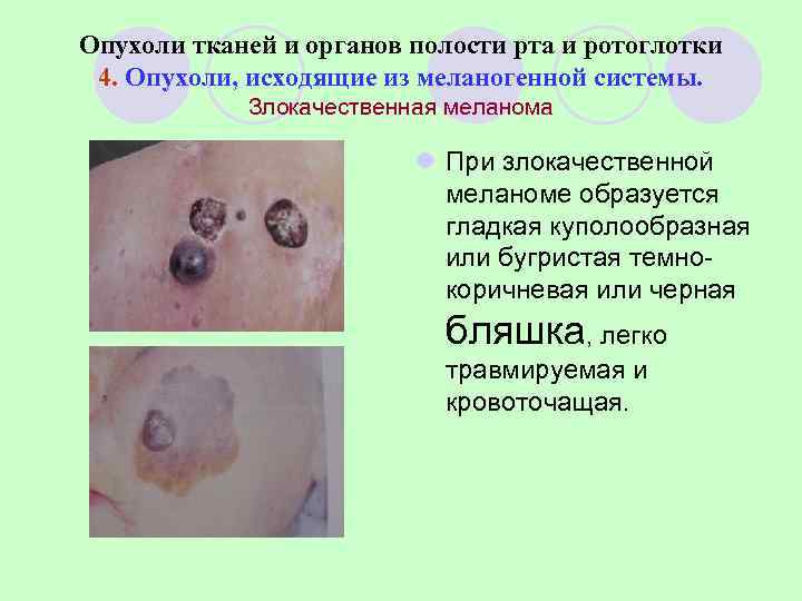 Опухоли тканей и органов полости рта и ротоглотки 4. Опухоли, исходящие из меланогенной системы.