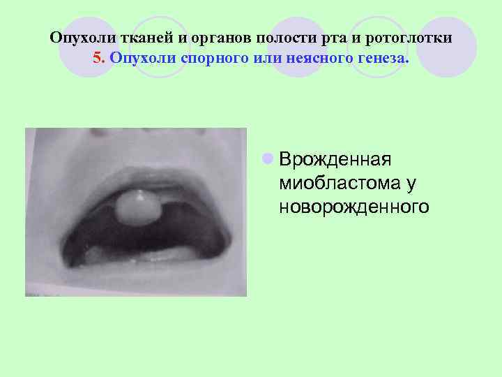 Опухоли тканей и органов полости рта и ротоглотки 5. Опухоли спорного или неясного генеза.