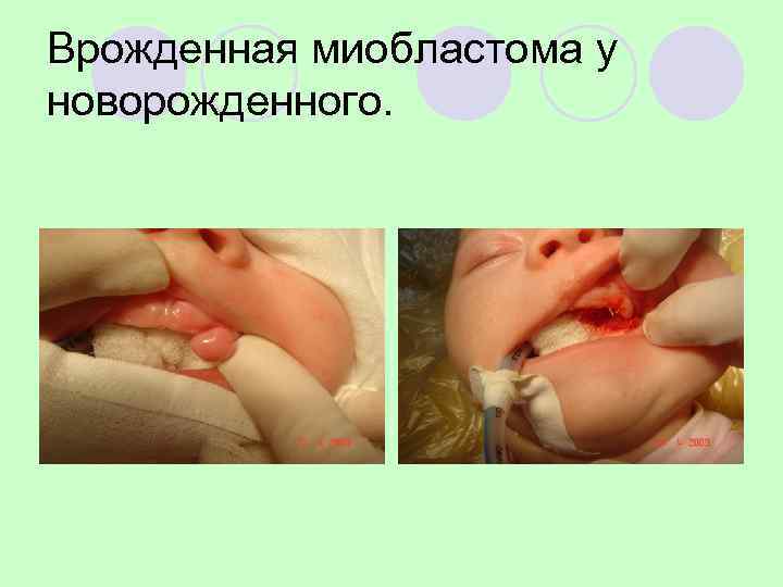 Врожденная миобластома у новорожденного. 