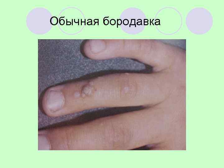 Обычная бородавка 
