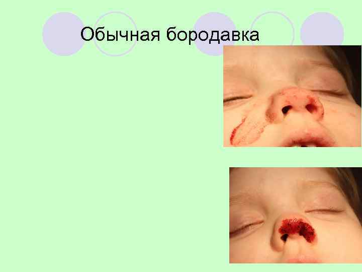 Обычная бородавка 