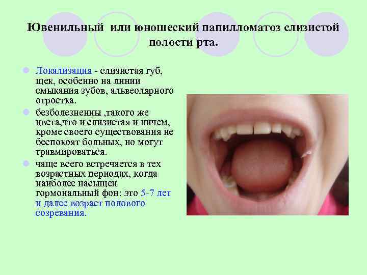  Ювенильный или юношеский папилломатоз слизистой    полости рта.  l Локализация