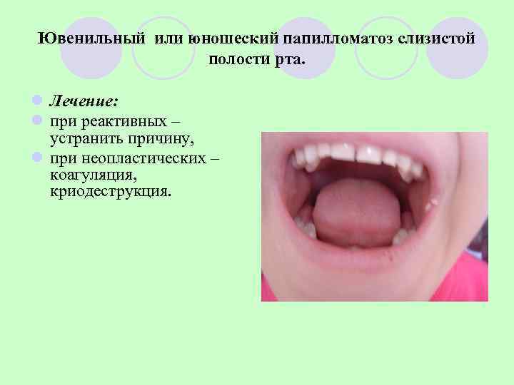 Ювенильный или юношеский папилломатоз слизистой   полости рта.  l Лечение: l при