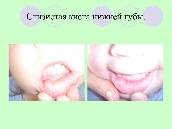Слизистая киста нижней губы. 