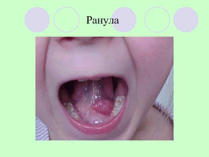 Ранула 