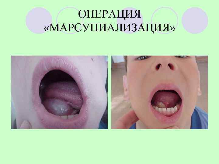   ОПЕРАЦИЯ «МАРСУПИАЛИЗАЦИЯ» 