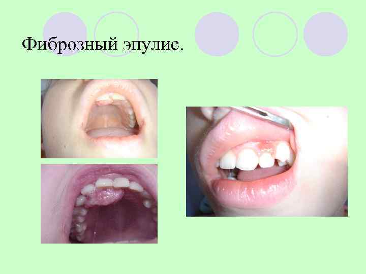 Фиброзный эпулис. 