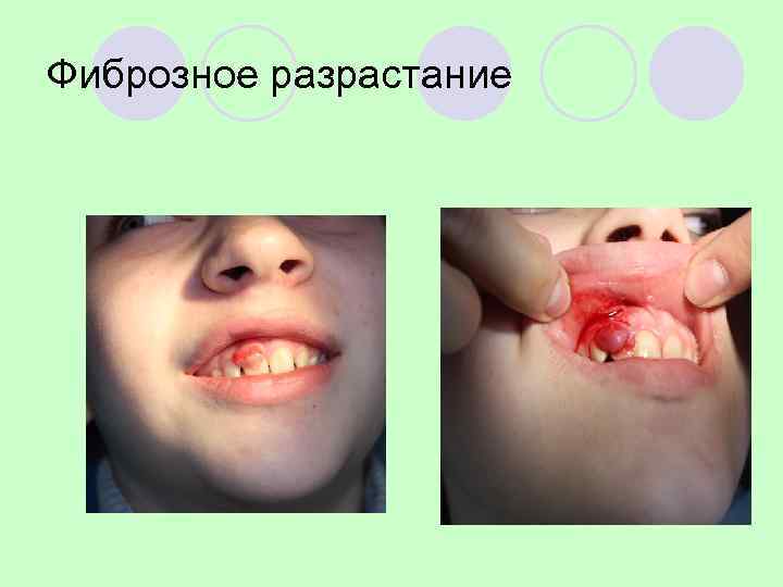 Фиброзное разрастание 