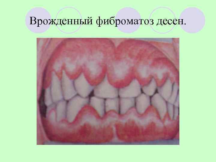 Врожденный фиброматоз десен. 