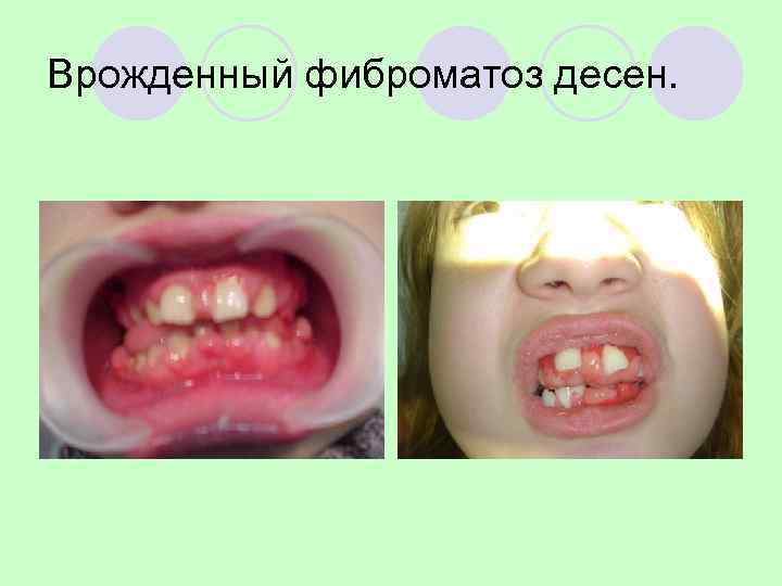 Врожденный фиброматоз десен. 